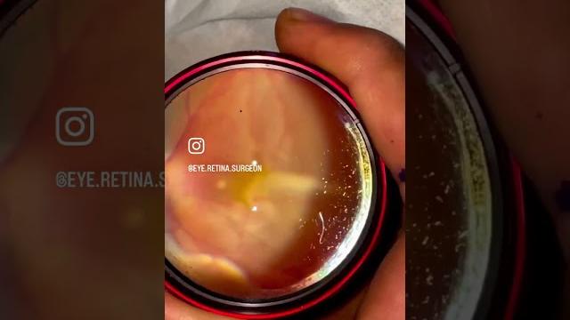 What is the retina? What is the retina?