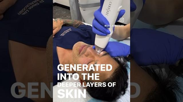 Rf micro-needling to regenerate collagen Rf micro-needling to regenerate collagen