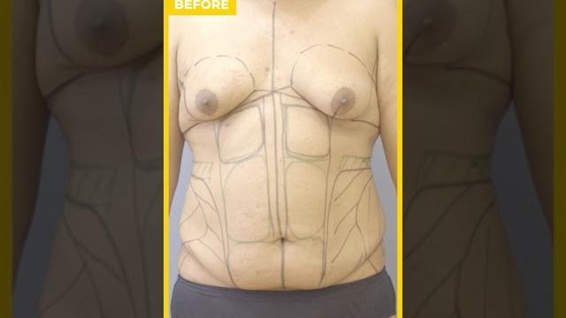 Transgender 360° transformation care before & after results #liposuction #hourglass #shorts Transgender 360° transformation care before & after results #liposuction #hourglass #shorts
