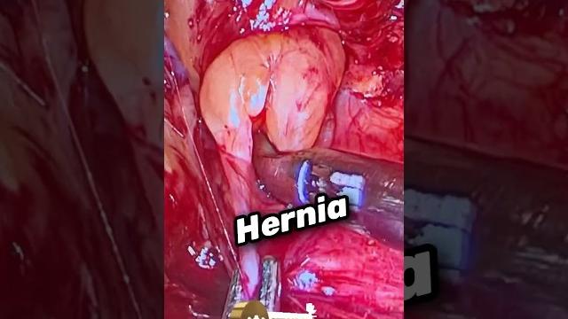 Real hernia in real life kaisa dikhta hai ?operation ke time hernia hole i actual hernia defect size Real hernia in real life kaisa dikhta hai ?operation ke time hernia hole i actual hernia defect size