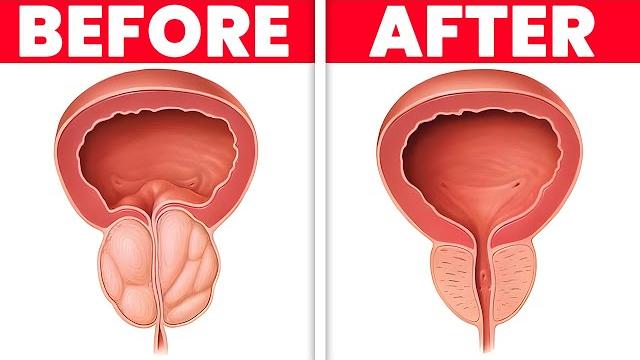 Drink 1 cup per day to shrink an enlarged prostate Drink 1 cup per day to shrink an enlarged prostate