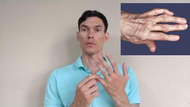 Артроз пальцев рук разработка arthrosis of the fingers Артроз пальцев рук разработка arthrosis of the fingers