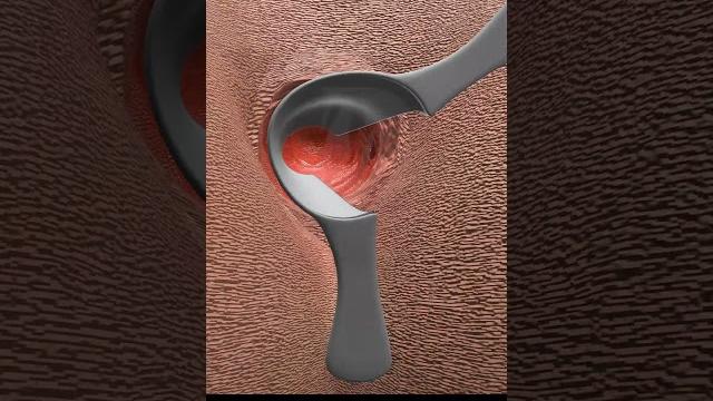 Why do i need fistula surgery? #shorts #fistula Why do i need fistula surgery? #shorts #fistula