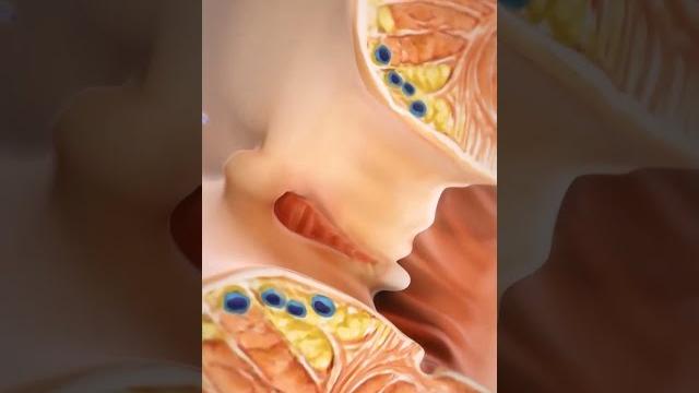 Anal fissure laser surgery treatment #viral Anal fissure laser surgery treatment #viral